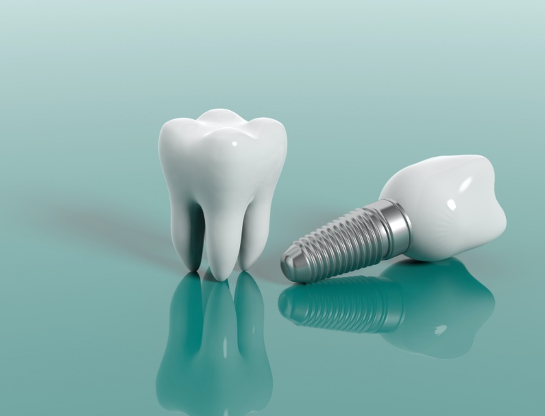 Dental Implants: What You Need To Know